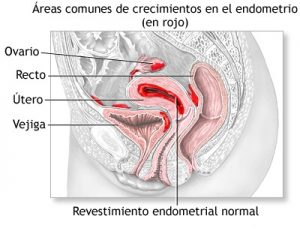 Endometriosis  Endometriosis EMDOMETRIOSIS 1 300x240