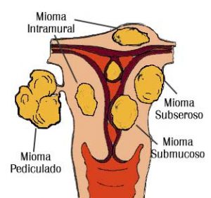 Los Miomas miomas 1 1 300x282