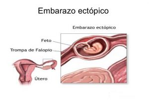 embarazo ectopico  Embarazo Ectópico embarazo ectopico 1 300x225