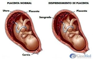 placenta  Placenta desprendimiento de placenta 1 300x191