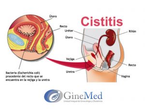 Cistitis  Cistitis Cistitis 1 300x225