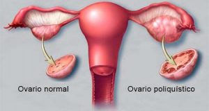 Ovario Poliquisticos clínica de ginecología en guadalajara Clínica de Ginecología en Guadalajara Ovarios Poliquisticos 300x160