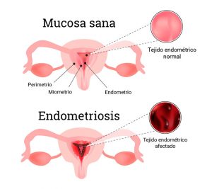 Ginecólogos en Guadalajara La Endometriosis  Ginecólogos en Guadalajara endometriosis 300x267
