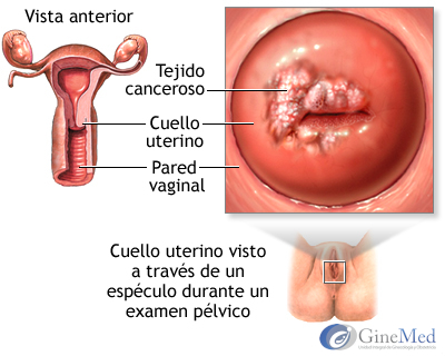 El Cáncer de Cuello Uterino en Zapopan el cáncer de cuello uterino en zapopan El Cáncer de Cuello Uterino en Zapopan El C  ncer de Cuello Uterino en Zapopan