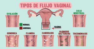 ¿Por qué se produce el Flujo Vaginal? ¿por qué se produce el flujo vaginal? ¿Por qué se produce el Flujo Vaginal? flujo 1 300x157