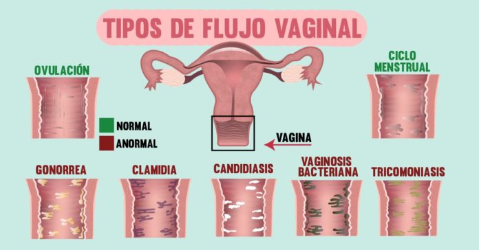 ¿Por qué se produce el Flujo Vaginal? ¿por qué se produce el flujo vaginal? ¿Por qué se produce el Flujo Vaginal? flujo 1