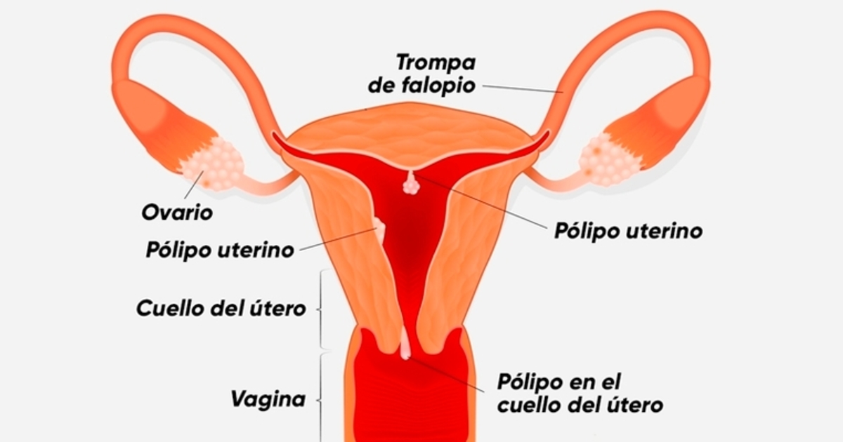 Secreciones Benignas pólipos uterinos zapopan Pólipos Uterinos Zapopan P  lipo Uterino 1