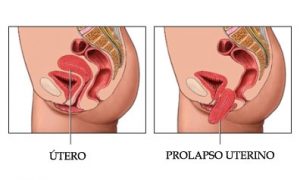 prolapso uterino zapopan Prolapso Uterino Zapopan UTERO 2 300x180