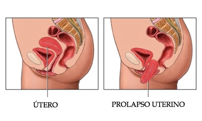 prolapso uterino zapopan Prolapso Uterino Zapopan UTERO 2