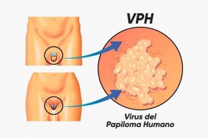 Tratamiento VPH Guadalajara) tratamiento vph guadalajara Tratamiento VPH Guadalajara VPH Cirug  a con L  ser 2 300x200