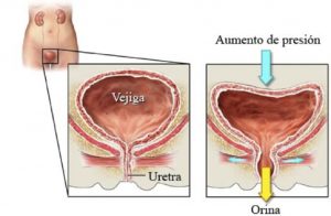 Cirugía para la incontinencia urinaria en mujeres Guadalajara cirugía para la incontinencia urinaria en mujeres guadalajara Cirugía para la incontinencia urinaria en mujeres Guadalajara incontinencia 1 300x196