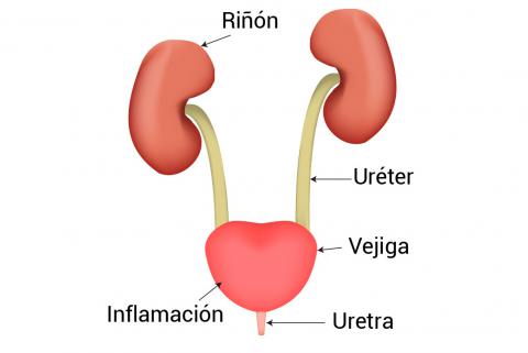 Síntomas de una Infección Urinaria Guadalajara síntomas de una infección urinaria guadalajara Síntomas de una Infección Urinaria Guadalajara infeccion 1 1