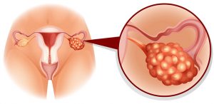 Síndrome de Ovario Poliquístico Zapopan síndrome de ovario poliquístico zapopan Síndrome de Ovario Poliquístico Zapopan ovario 11 300x146