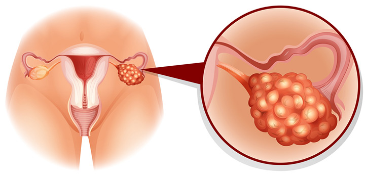 Síndrome de Ovario Poliquístico Zapopan síndrome de ovario poliquístico zapopan Síndrome de Ovario Poliquístico Zapopan ovario 11