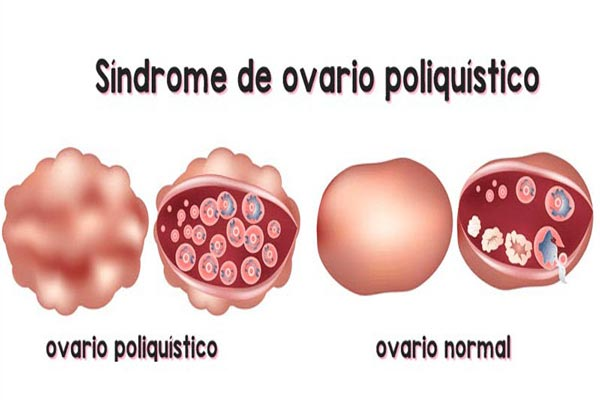 Síndrome de Ovario Poliquístico Zapopan síndrome de ovario poliquístico zapopan Síndrome de Ovario Poliquístico Zapopan ovario 2