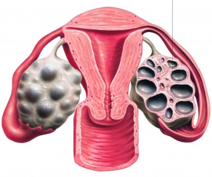 Síndrome de Ovario Poliquístico Zapopan síndrome de ovario poliquístico zapopan Síndrome de Ovario Poliquístico Zapopan ovario 3