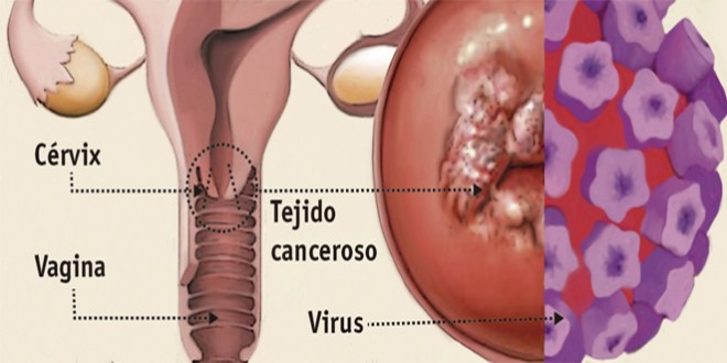 ¿De qué manera el VPH causa Cáncer de Cuello Uterino? Zapopan ¿de qué manera el vph causa cáncer de cuello uterino? zapopan ¿De qué manera el VPH causa Cáncer de Cuello Uterino? Zapopan vph 1 1