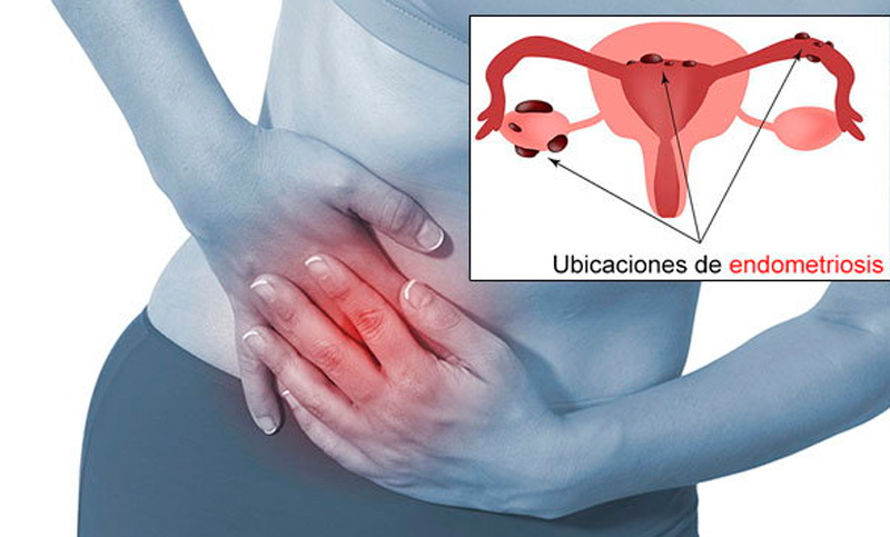 La Endometriosis Guadalajara la endometriosis guadalajara La Endometriosis Guadalajara ENDOMETRIO 3
