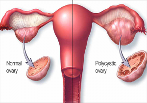 Síndrome de Ovarios Poliquísticos Guadalajara síndrome de ovarios poliquísticos guadalajara Síndrome de Ovarios Poliquísticos Guadalajara GINE 1 300x210