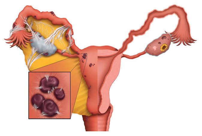 La Endometriosis y sus 3 Pilares Guadalajara  La Endometriosis y sus 3 Pilares Guadalajara GINE 1