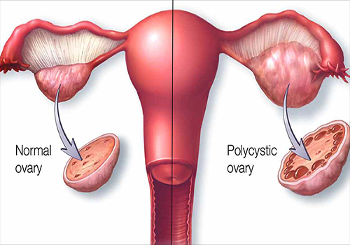 Síndrome de Ovarios Poliquísticos Guadalajara síndrome de ovarios poliquísticos guadalajara Síndrome de Ovarios Poliquísticos Guadalajara GINE 1