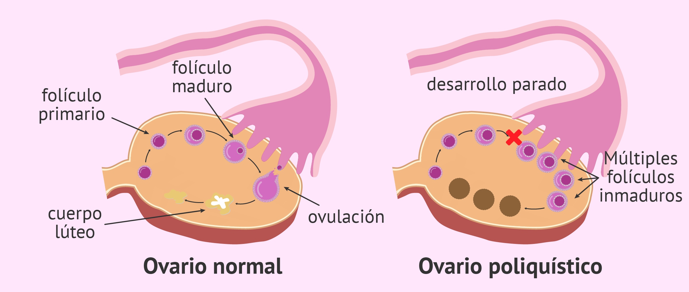 Síndrome de Ovarios Poliquísticos Guadalajara síndrome de ovarios poliquísticos guadalajara Síndrome de Ovarios Poliquísticos Guadalajara GINE 3 1