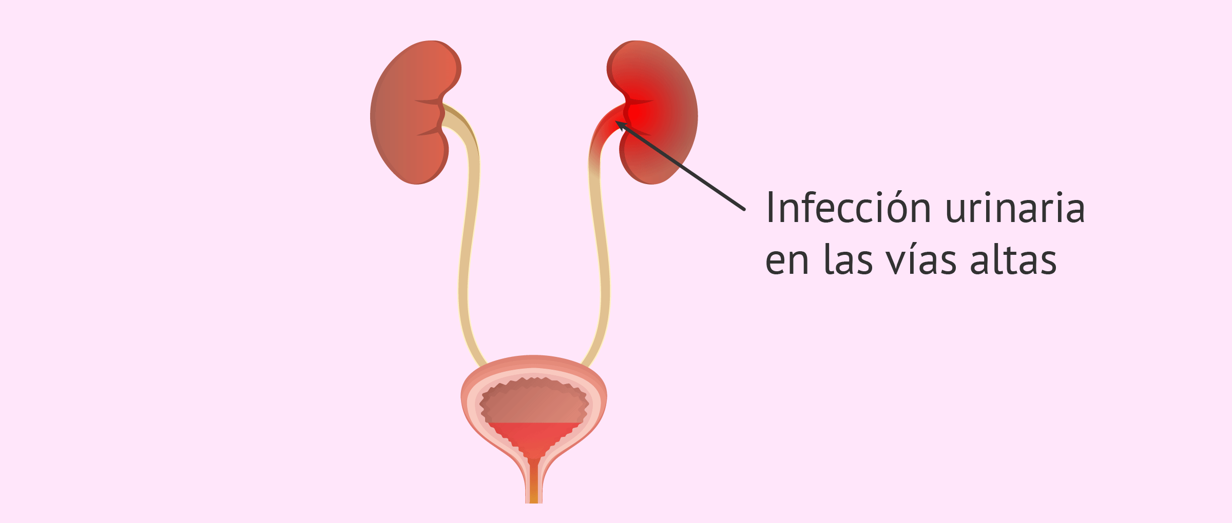 Infecciones Urinaria Guadalajara infecciones urinaria guadalajara Infecciones Urinaria Guadalajara infeccion 1