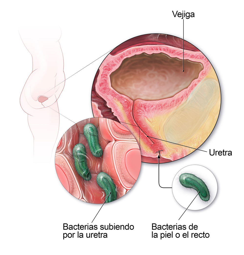 Infecciones Urinaria en Guadalajara infecciones urinaria en guadalajara Infecciones Urinaria en Guadalajara INFECCION 1